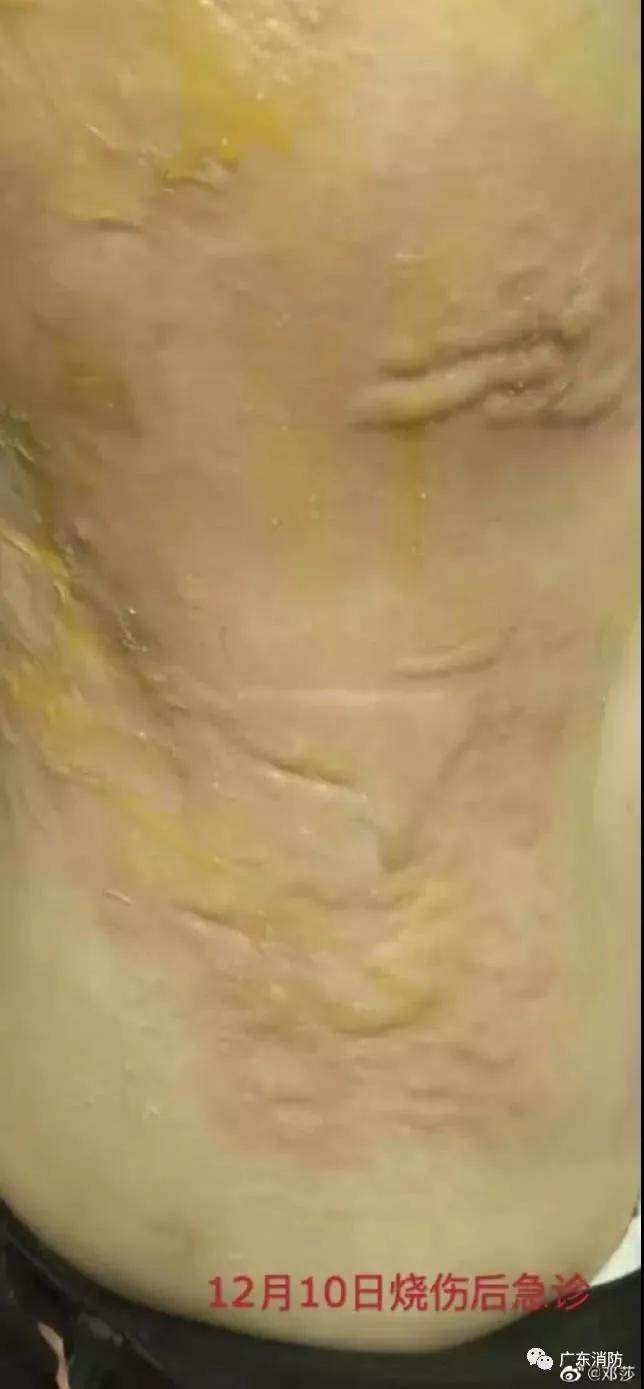 拔火罐烧伤的明星,明星拔火罐烧伤