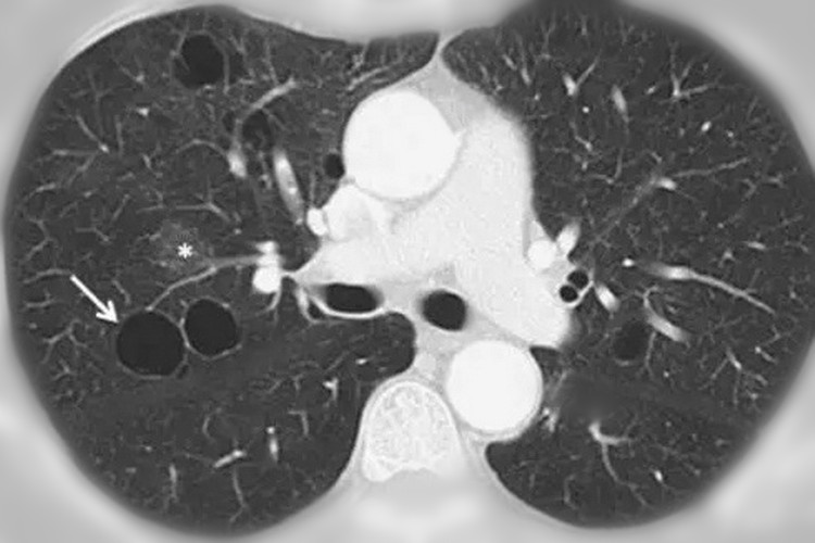 肺大疱的诊断标准,肺大泡是如何引起的