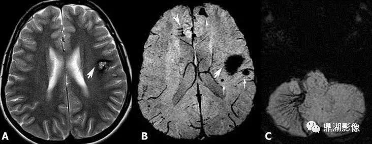颅内海绵状血管瘤的增强影像,脑内海绵状血管瘤影像表现