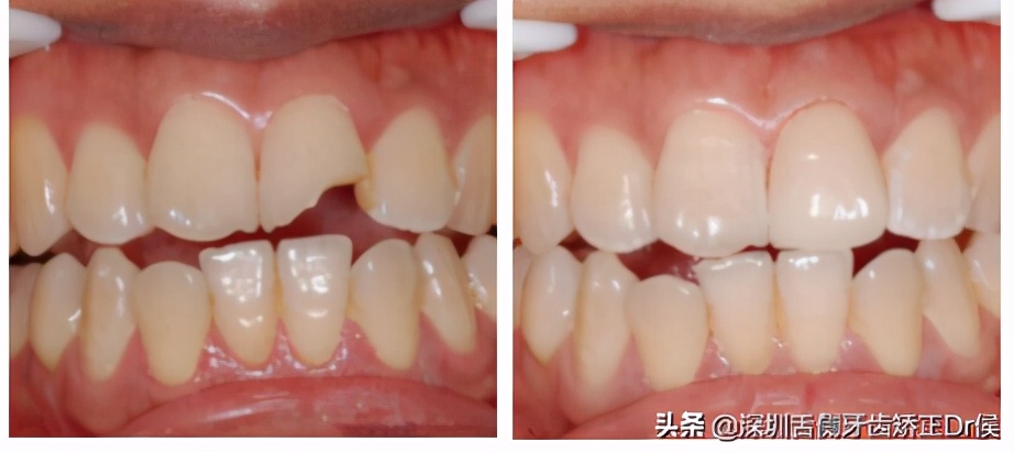 牙断了还连着肉怎么办,烤瓷牙套里的牙断了怎么办