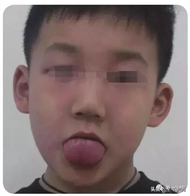 手足口病水痘荨麻疹有什么区别,麻疹水痘手足口病皮疹的区别