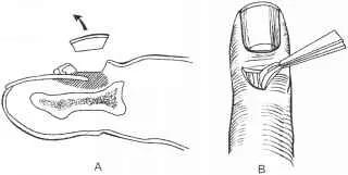 困扰小岳岳的甲沟炎,有没有好的治疗方法?医生给相声粉丝的科普