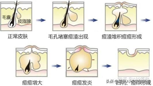 网传去痘印药膏致烂脸？想去红痘印，这款国货精华完胜大牌修丽可