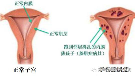 痛经医生建议上环,为什么医生建议上环而不是结扎
