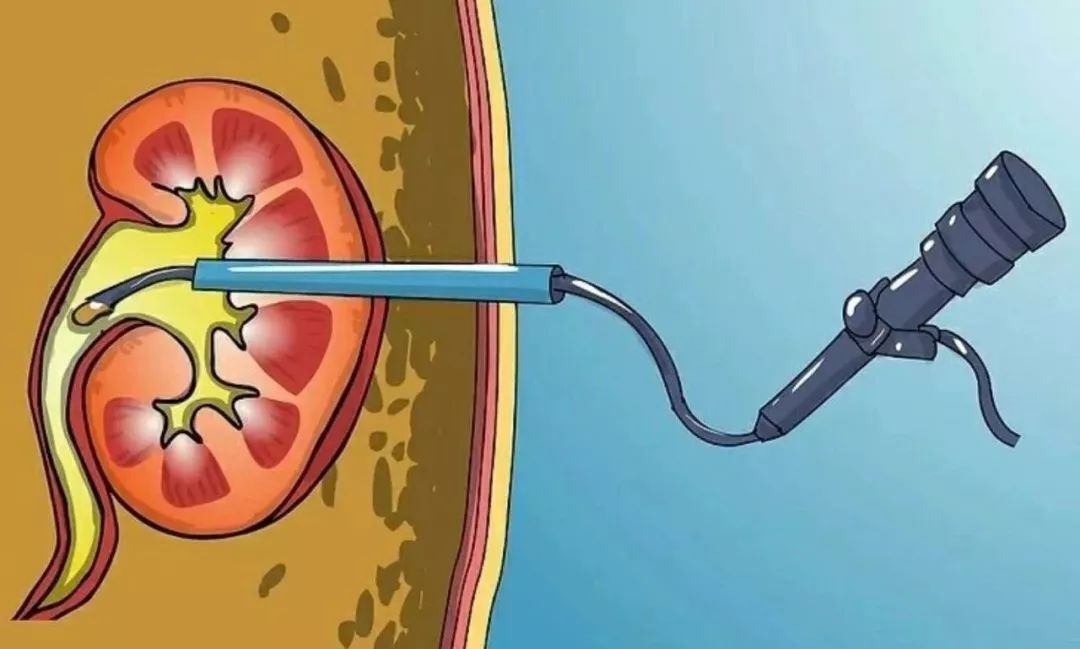 肾结石尿尿疼痛怎么办,肾结石如果尿尿恢复正常还是很疼