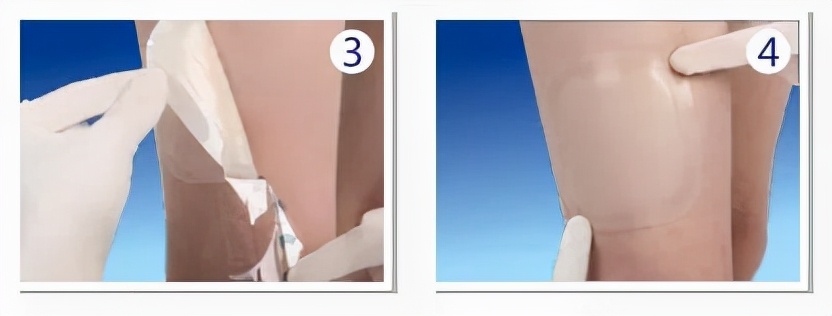 下肢静脉淤积性溃疡,下肢静脉性溃疡挂哪个科