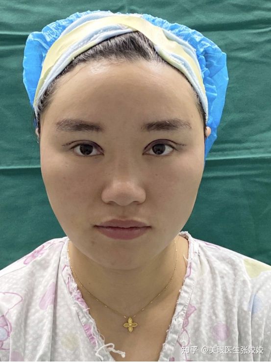 贴了双眼皮贴后的真实效果,贴双眼皮贴容易起翘