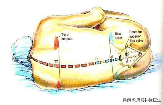 局部麻醉是什么体验,麻醉就是麻醉什么感觉