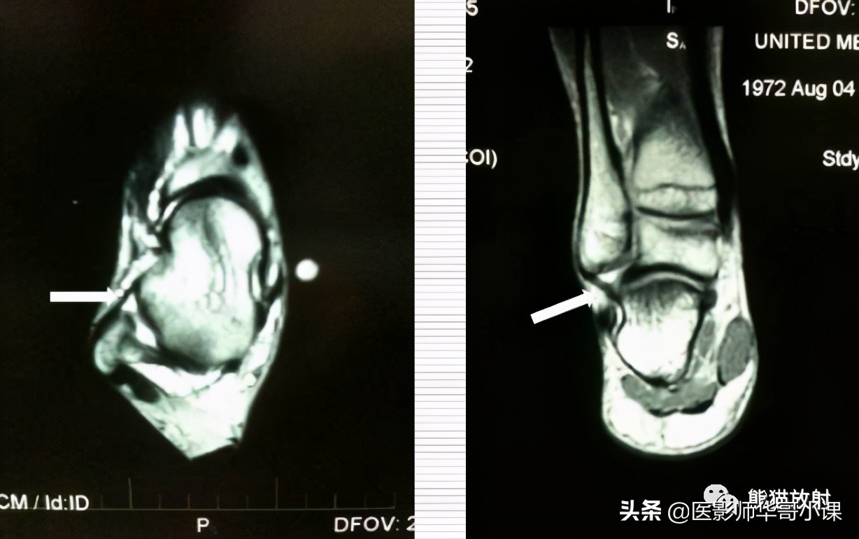 踝关节解剖视频课,解剖学韧带分布图