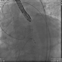 微创人工主动脉瓣膜置换术,微创介入主动脉瓣膜置换术