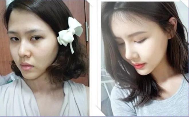 膨体材料真的很难取吗,膨体怎么取出来