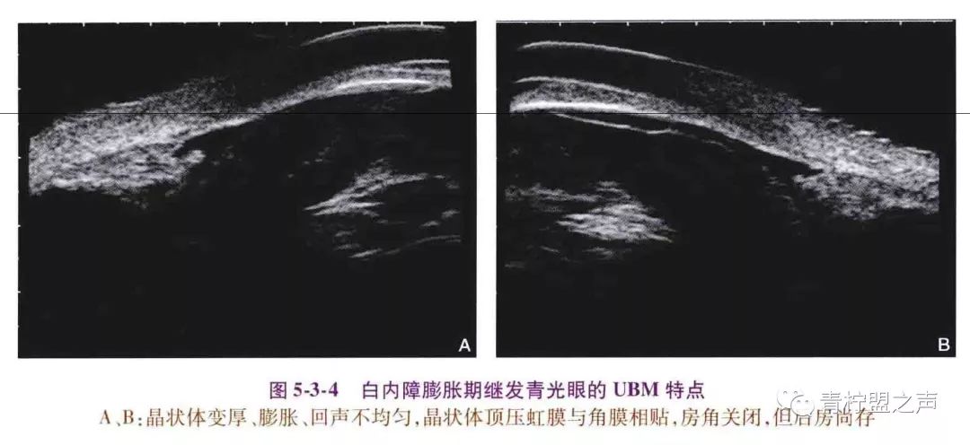 青光眼和白内障可以同时做吗,青光眼和白内障可以同时做手术吗
