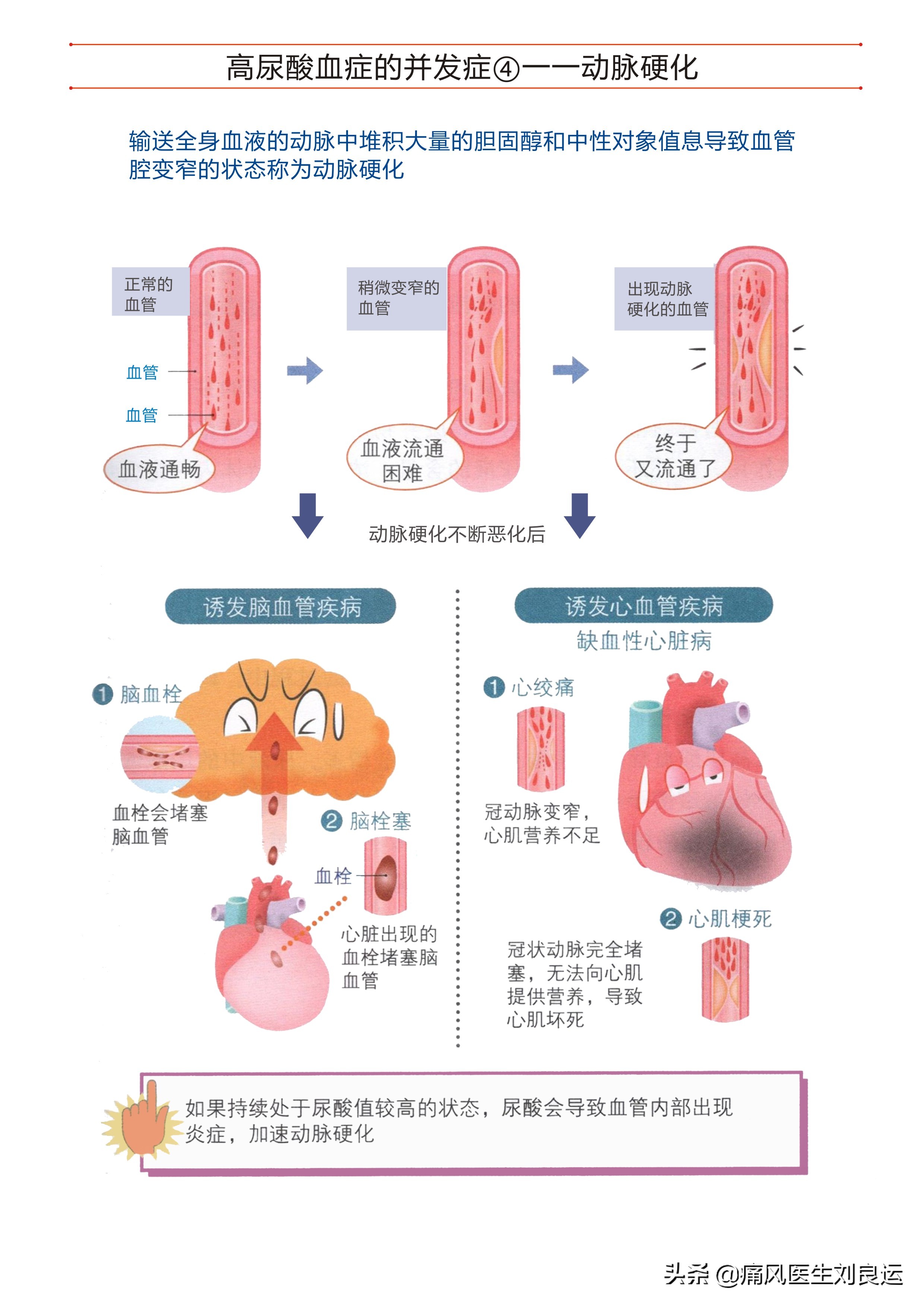 高尿酸没有症状到底要不要吃药,尿酸偏高怎么让尿酸下去