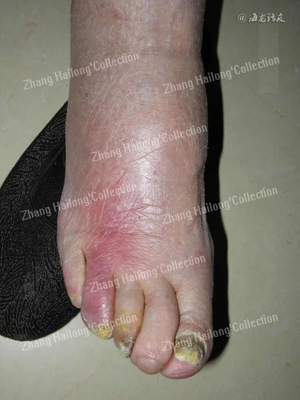 足癣和丹毒的区别,足癣和脚气一样吗