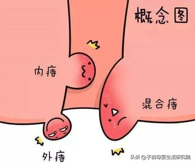 孕期痔疮高发这样护理才有效,孕妇痔疮高发怎么办