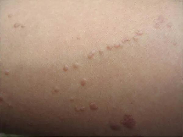 乙肝患者皮肤发黄还意味着什么,乙肝患者皮肤出现红点