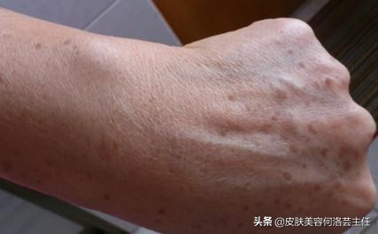 脸上有黑色素沉着斑怎能治好,脸上有色斑的护肤教程