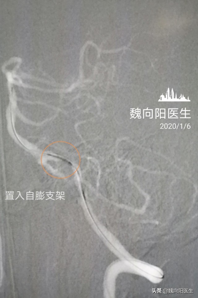 放入支架腰疼怎么办,支架后头晕怎么回事