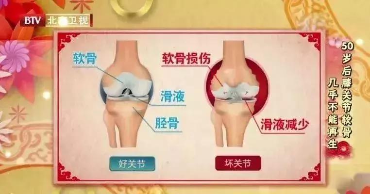 抽关节积液有什么危害,关节积液到底抽还是不抽