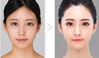 关于瘦脸针的小常识你都了解多少,瘦脸针人人都可以打吗科普篇