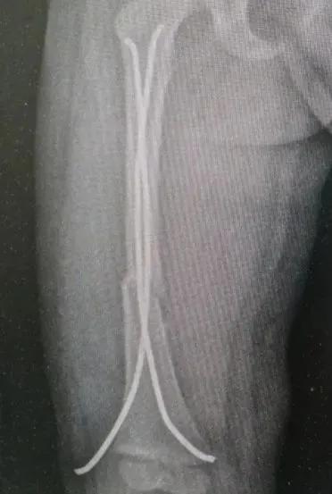 景谷县人民医院外二科微创治疗小儿骨折，让骨折的孩子少受苦