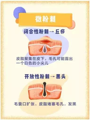 怎么去除脸上痘印痘坑痘痕,预防痘坑买什么