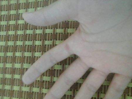 手脚起小水泡特别痒怎么根治,手脚生水泡奇痒什么原因