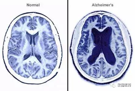 预防老年痴呆吃什么食物最佳,常吃4种食物预防老年痴呆症