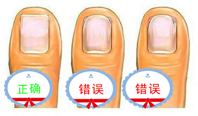 甲沟炎的处理方法视频,甲沟炎处理小视频