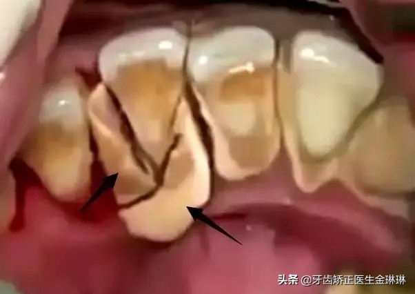 严重牙结石洗牙会疼吗,洗牙只洗牙结石不洗牙齿表面好吗