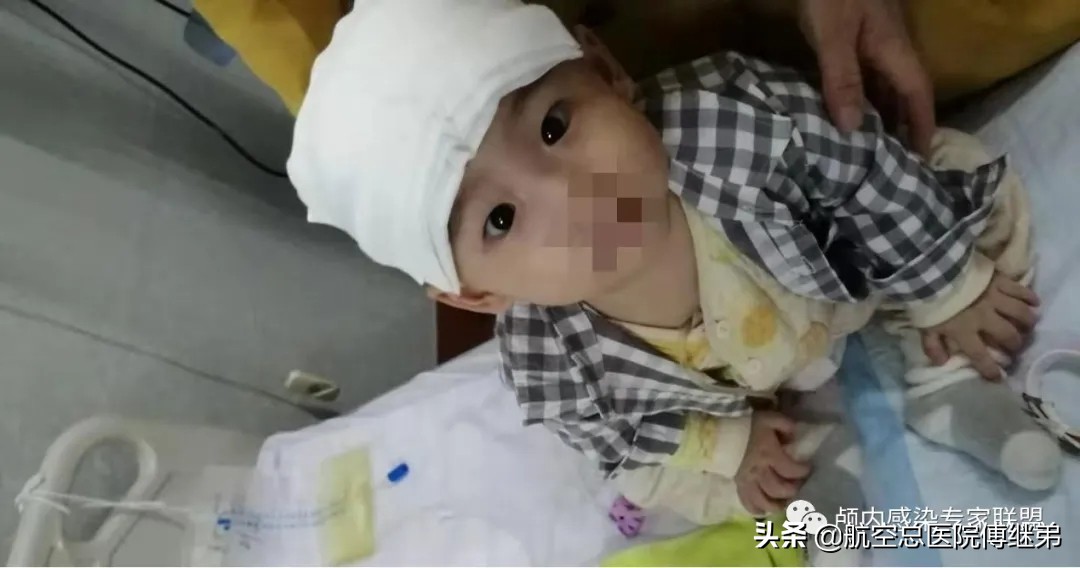 婴儿脑积水治疗方法动画演示,ommaya囊植入术是大手术吗