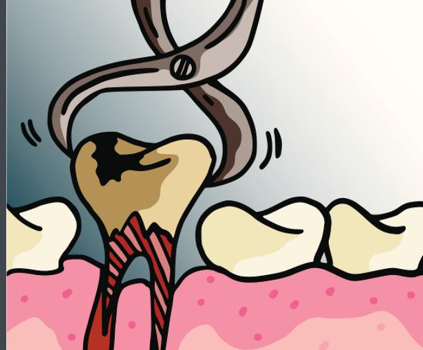 拔智齿出血过多导致死亡,智齿拔牙后流血止血妙招