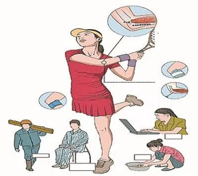 网球肘肌肉劳损,网球肘造成胳膊弯了最佳治疗方法