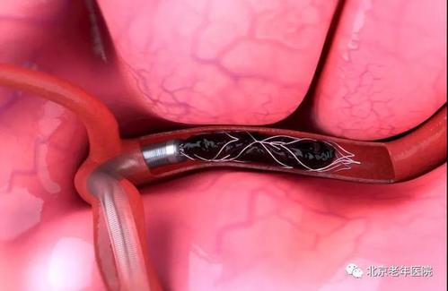 老年人脑梗塞康复锻炼方法,脑梗塞锻炼走路视频大全