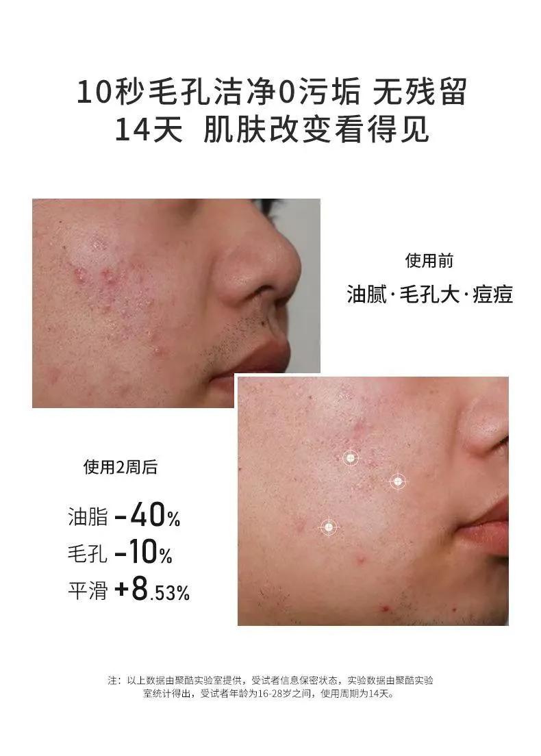 油性肌肤毛孔粗大怎么改善,油性肌肤怎么收缩毛孔