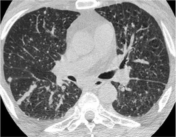 间质性肺疾病看病经验分享,分享肺腺癌临床实验的例子