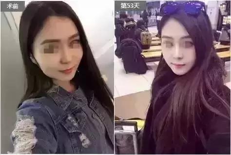 解密瘦脸针的几大常识性问题,关于瘦脸针的真实事件