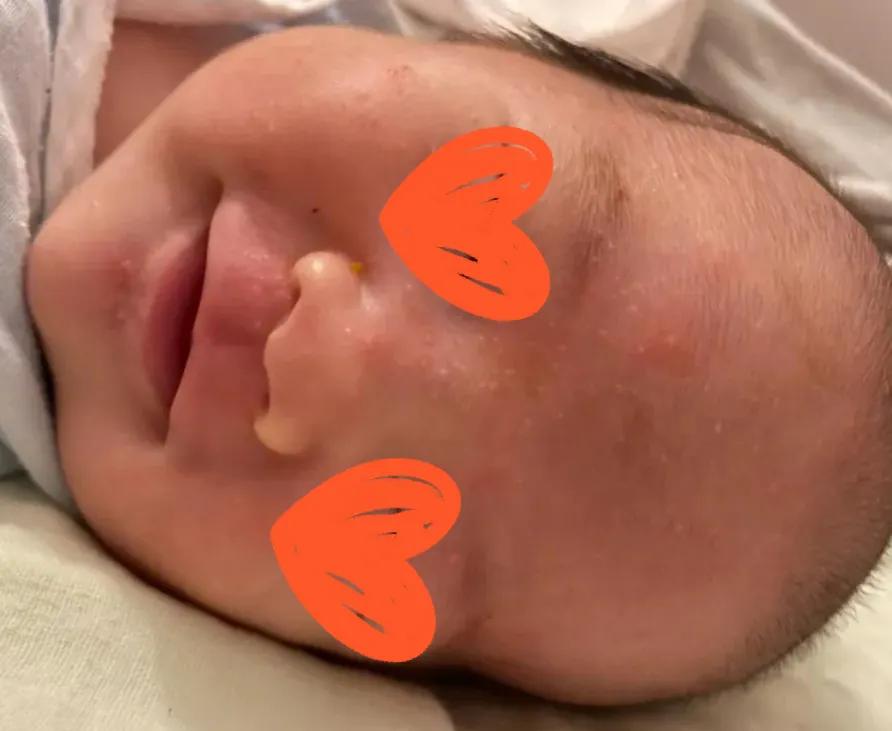 养宠物会不会造成孩子湿疹,宝宝湿疹跟家里养宠物有关系吗