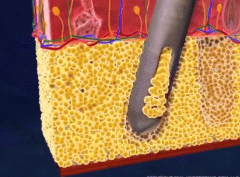 瘦的代价是什么,抽脂代价
