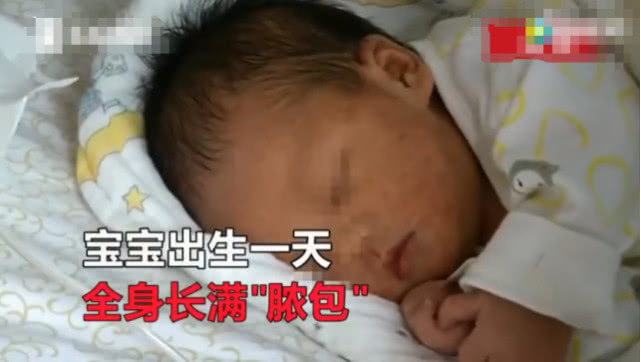 新生儿出生一身疙瘩,新生儿出生身上红疙瘩上面带白点