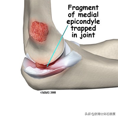 肘关节康复锻炼过度会造成什么,运动过量肘关节损伤如何恢复
