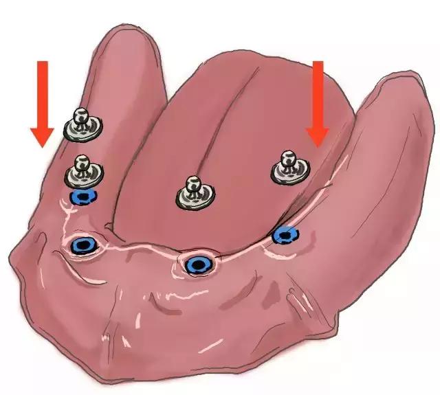 镶牙手绘图,镶牙图片过程