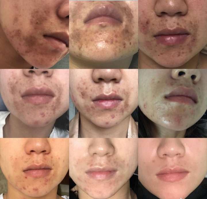 祛除痘坑痘印药膏,男士痘印痘坑怎么去除