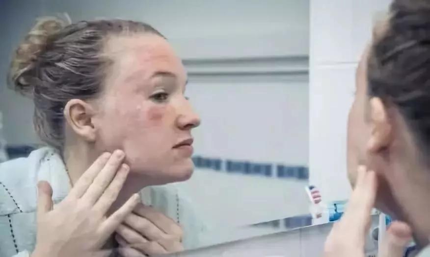 拯救痘痘烂脸用什么药,拯救痘痘烂脸这个小窍门你知道吗