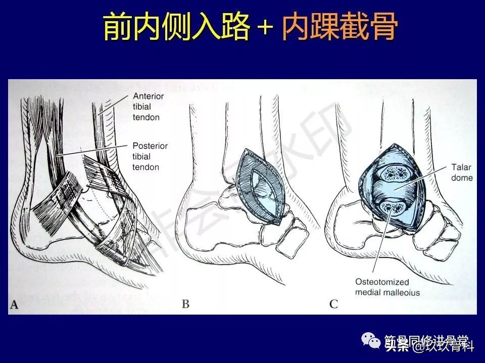 距骨骨折后遗症,距骨骨折怎么办
