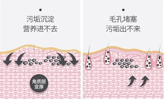 去角质慕斯可以去除死皮么,去角质慕斯去不去死皮