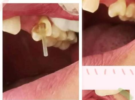 牙齿残根拔掉有什么危害吗,牙齿残根残冠要不要拔掉