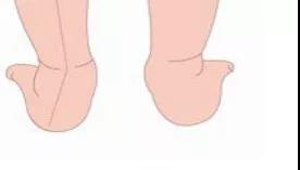扁平足的危害怎么形成的,扁平足的危害和治疗方法