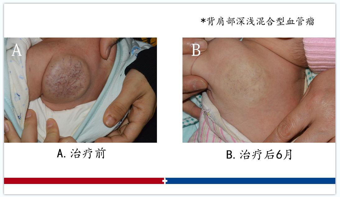 血管瘤复发的六大原因,血管瘤一直发作怎么回事