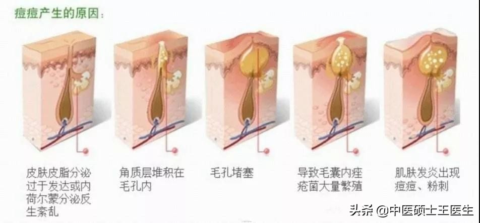 中医祛痘多少钱,中医祛痘挂什么科